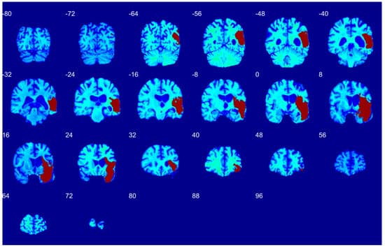 Open-source stroke lesion segmentation for VLSM at scale